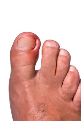 person getting help with Ingrown Toenails at Helensvale clinic
