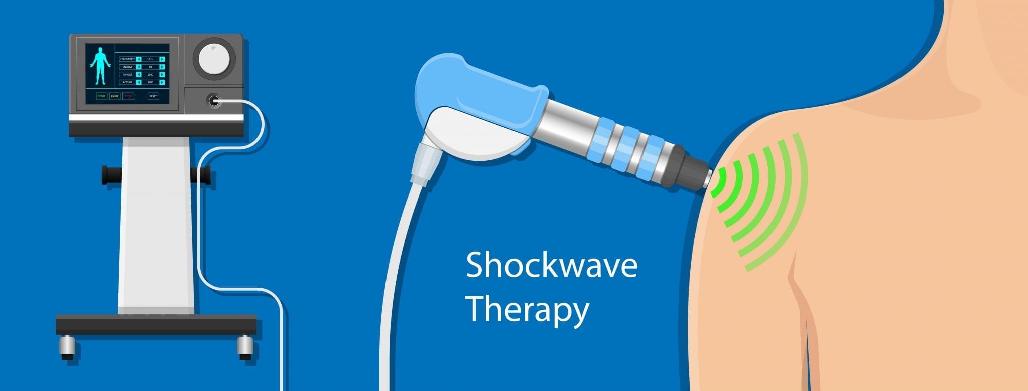 Shockwave therapy for hamstring tightness - Spine Sport Feet